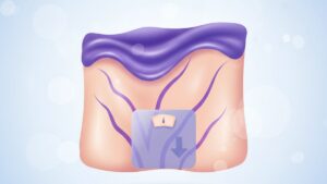 Purple Stretch Marks & Weight Loss: What’s Really Happening?