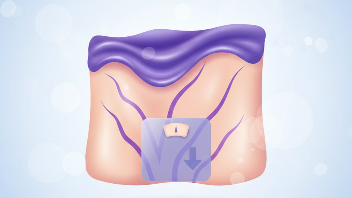 Purple Stretch Marks & Weight Loss: What’s Really Happening?